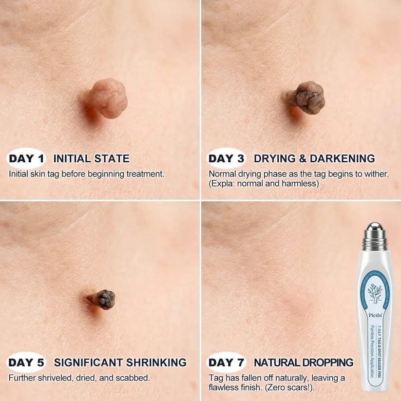 Picdo® – Stylo Soin Ciblé pour les Imperfections de la Peau